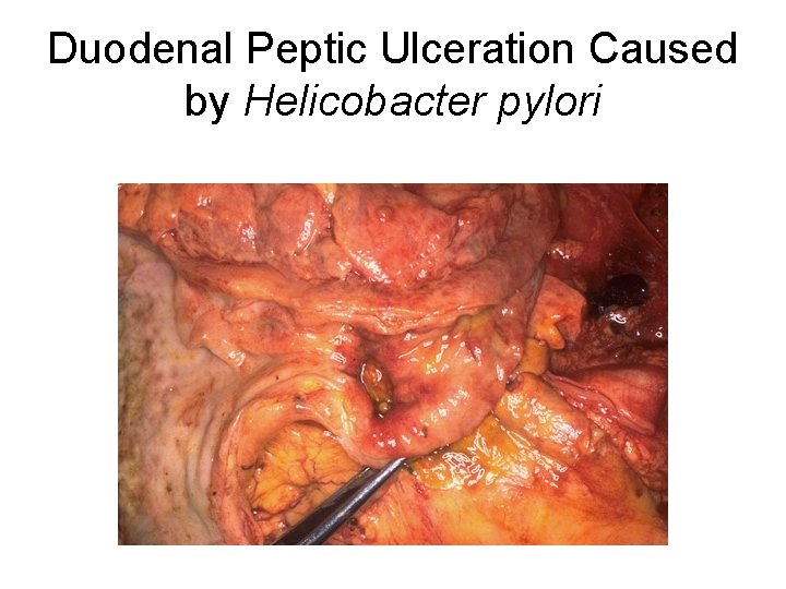 Duodenal Peptic Ulceration Caused by Helicobacter pylori 