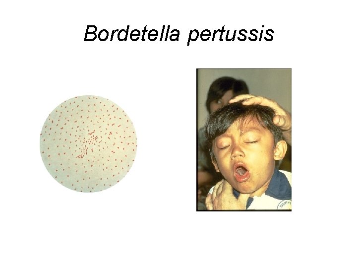 Bordetella pertussis 