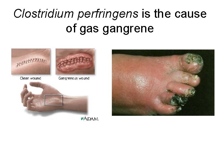 Clostridium perfringens is the cause of gas gangrene 