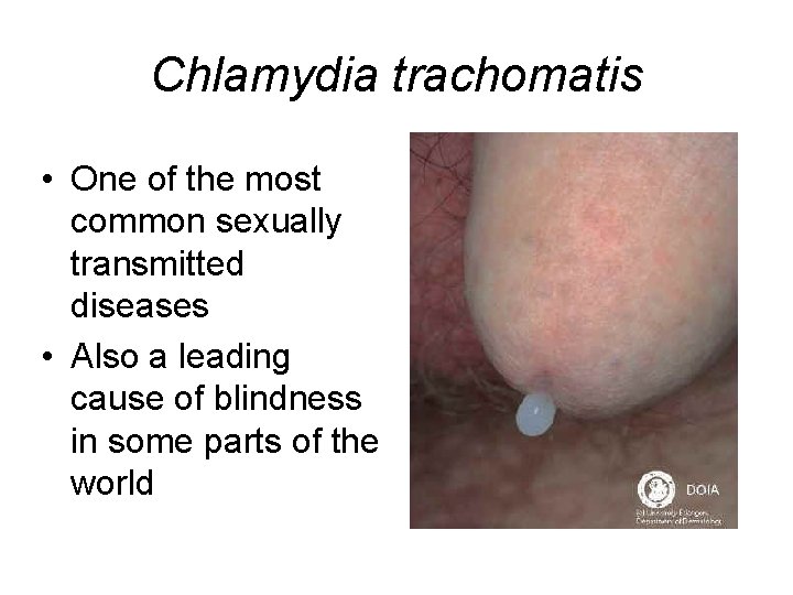 Chlamydia trachomatis • One of the most common sexually transmitted diseases • Also a