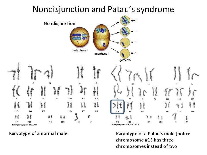 Nondisjunction and Patau’s syndrome Nondisjunction Karyotype of a normal male Karyotype of a Patau’s