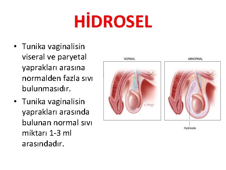 HİDROSEL • Tunika vaginalisin viseral ve paryetal yaprakları arasına normalden fazla sıvı bulunmasıdır. •