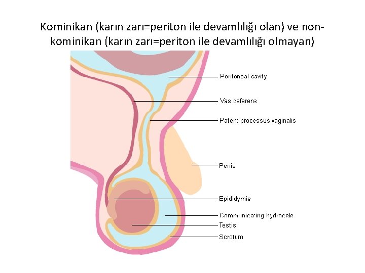 Kominikan (karın zarı=periton ile devamlılığı olan) ve nonkominikan (karın zarı=periton ile devamlılığı olmayan) 