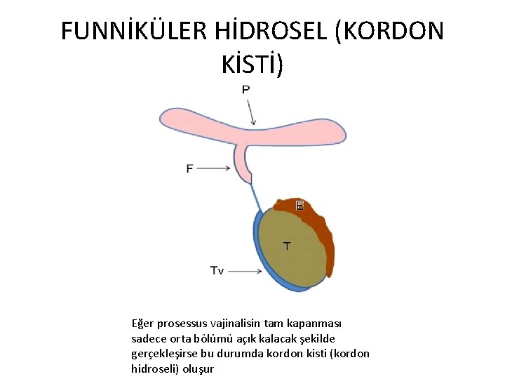 FUNNİKÜLER HİDROSEL (KORDON KİSTİ) Eğer prosessus vajinalisin tam kapanması sadece orta bölümü açık kalacak