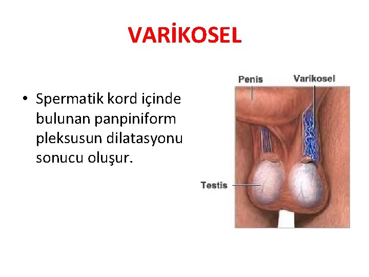 VARİKOSEL • Spermatik kord içinde bulunan panpiniform pleksusun dilatasyonu sonucu oluşur. 