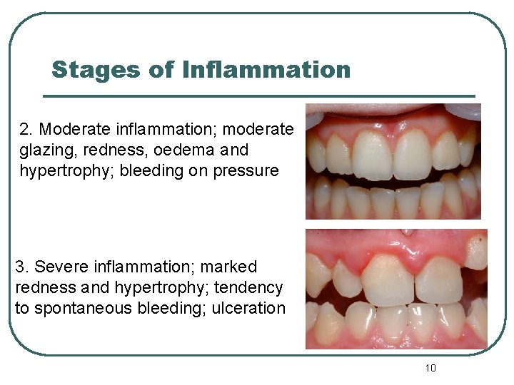 Stages of Inflammation 2. Moderate inflammation; moderate glazing, redness, oedema and hypertrophy; bleeding on