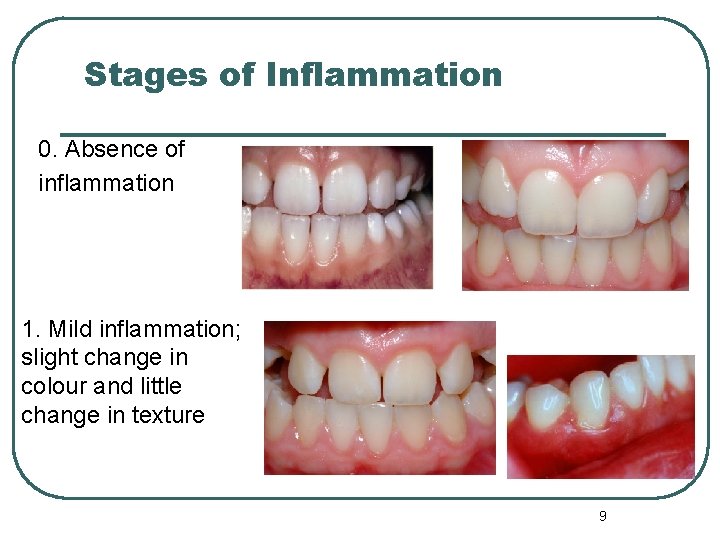 Stages of Inflammation 0. Absence of inflammation 1. Mild inflammation; slight change in colour