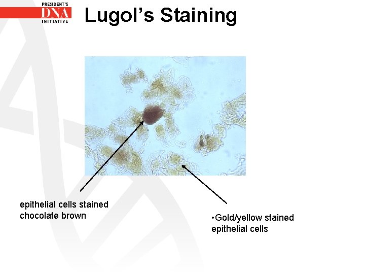 Lugol’s Staining epithelial cells stained chocolate brown • Gold/yellow stained epithelial cells 