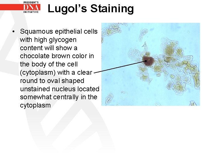 Lugol’s Staining • Squamous epithelial cells with high glycogen content will show a chocolate