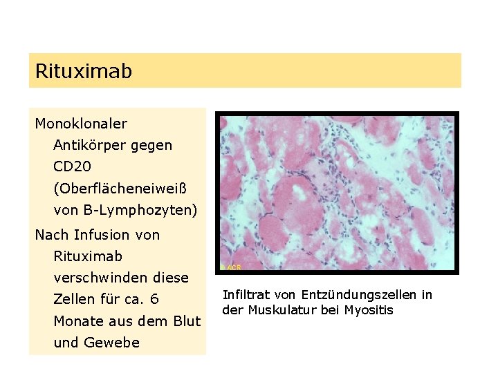 Rituximab Monoklonaler Antikörper gegen CD 20 (Oberflächeneiweiß von B-Lymphozyten) Nach Infusion von Rituximab verschwinden