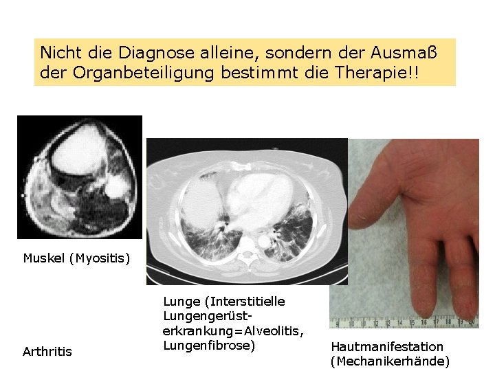 Nicht die Diagnose alleine, sondern der Ausmaß der Organbeteiligung bestimmt die Therapie!! Muskel (Myositis)