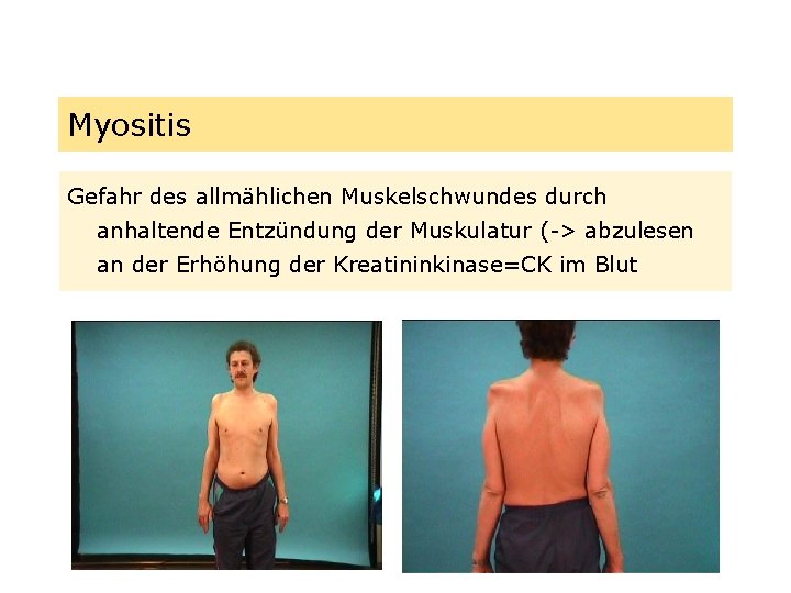 Myositis Gefahr des allmählichen Muskelschwundes durch anhaltende Entzündung der Muskulatur (-> abzulesen an der