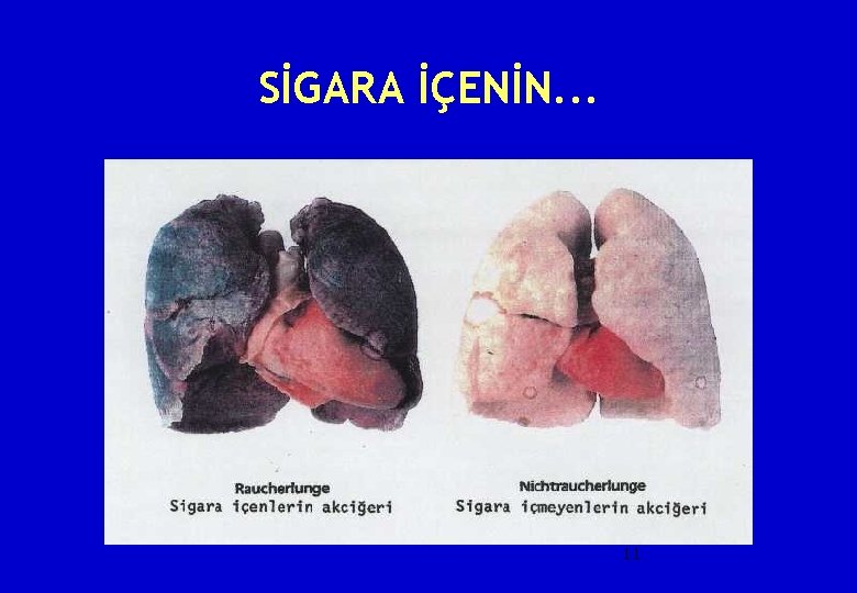 SİGARA İÇENİN. . . 11 