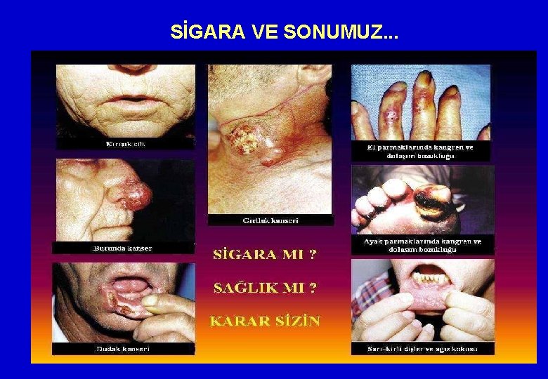 SİGARA VE SONUMUZ. . . 17 