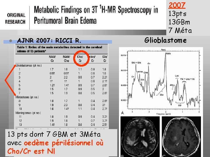 l AJNR 2007: RICCI R. 13 pts dont 7 GBM et 3 Méta avec