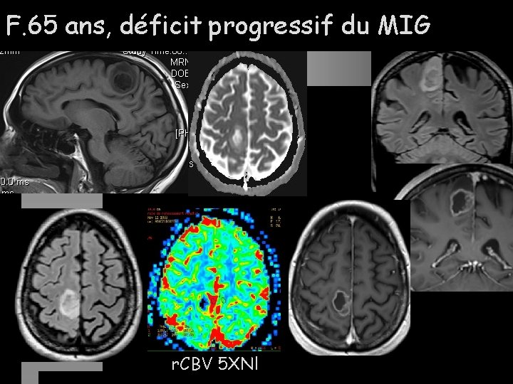 F. 65 ans, déficit progressif du MIG r. CBV 5 XNl 