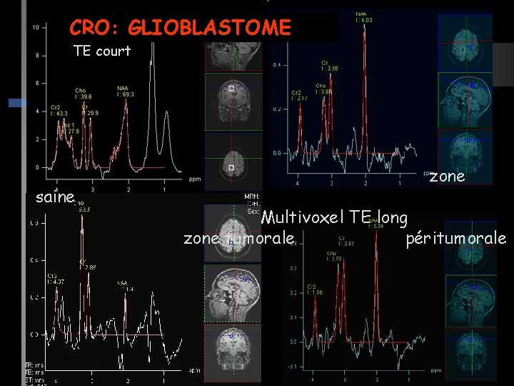 CRO: GLIOBLASTOME TE court saine zone Multivoxel TE long zone tumorale péritumorale 