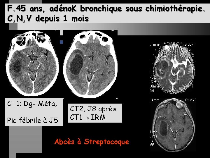 F. 45 ans, adéno. K bronchique sous chimiothérapie. C, N, V depuis 1 mois