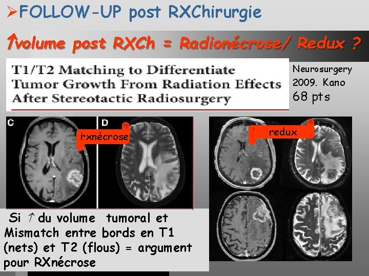 ØFOLLOW-UP post RXChirurgie volume post RXCh = Radionécrose/ Redux ? Neurosurgery 2009. Kano 68