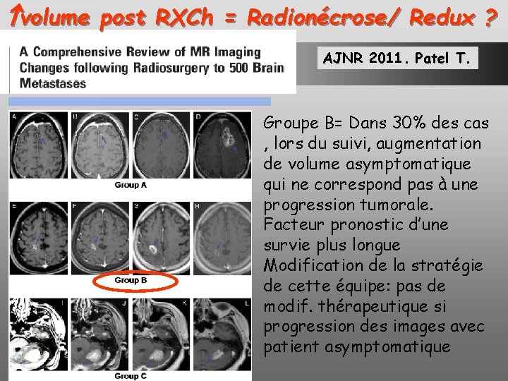  volume post RXCh = Radionécrose/ Redux ? AJNR 2011. Patel T. Groupe B=