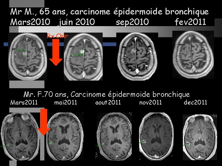 Mr M. , 65 ans, carcinome épidermoide bronchique Mars 2010 juin 2010 sep 2010