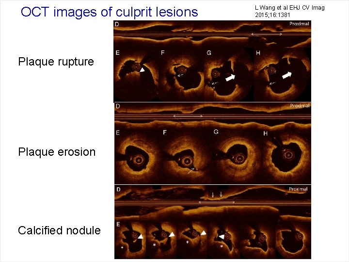 OCT images of culprit lesions Plaque rupture Plaque erosion Calcified nodule L Wang et