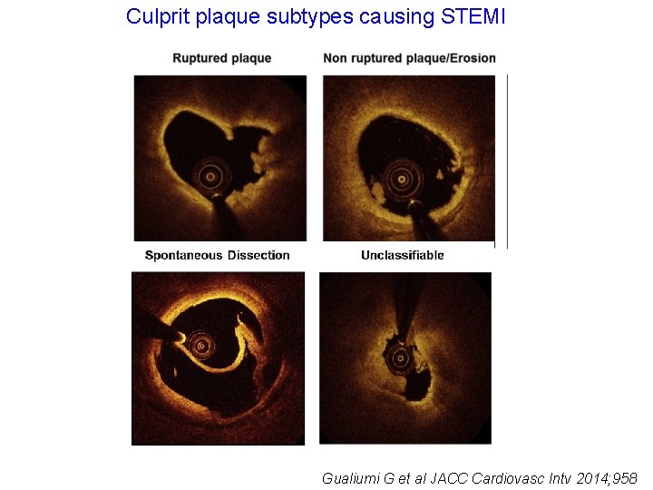 Culprit plaque subtypes causing STEMI Gualiumi G et al JACC Cardiovasc Intv 2014; 958