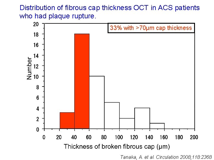 Distribution of fibrous cap thickness OCT in ACS patients who had plaque rupture. 33%