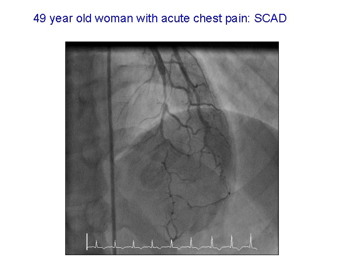 49 year old woman with acute chest pain: SCAD 