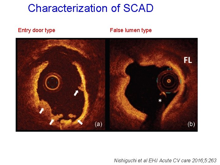 Characterization of SCAD Entry door type False lumen type Nishiguchi et al EHJ Acute