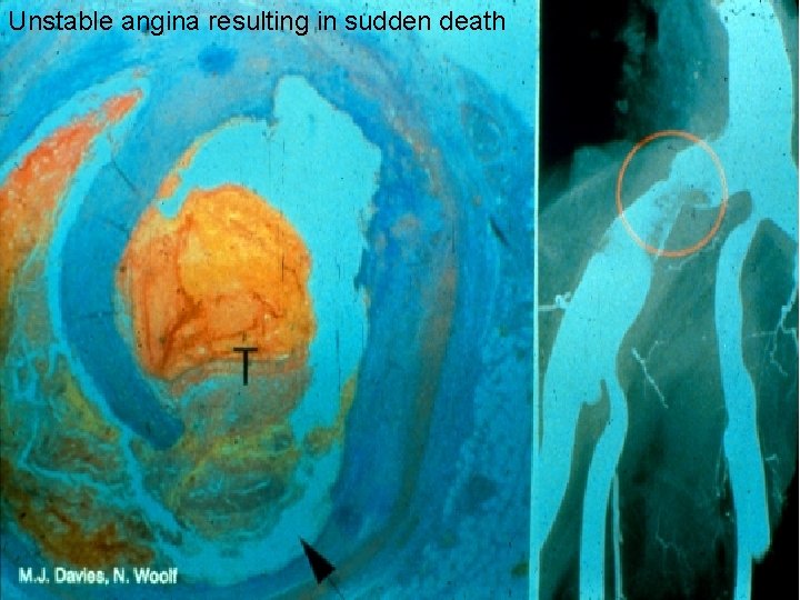 Unstable angina resulting in sudden death 