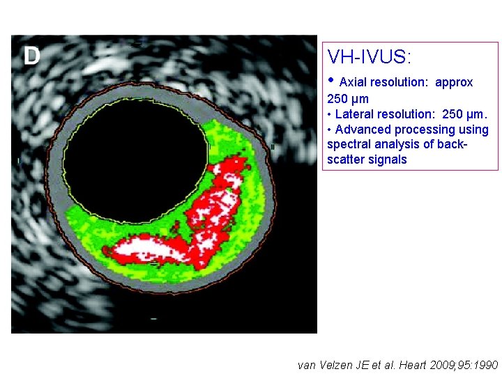 VH-IVUS: • Axial resolution: approx 250 μm • Lateral resolution: 250 μm. • Advanced