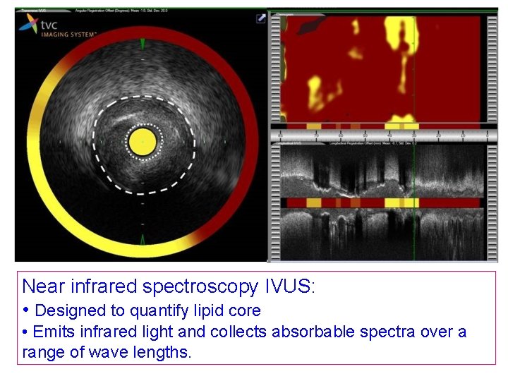 Near infrared spectroscopy IVUS: • Designed to quantify lipid core • Emits infrared light