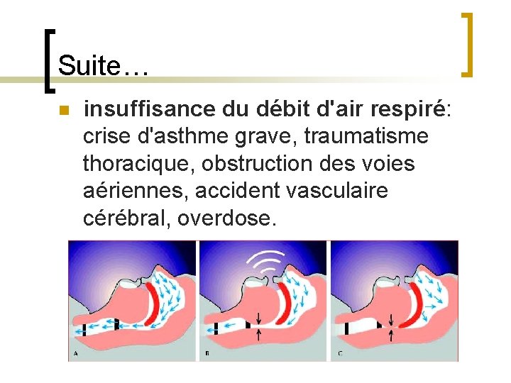 Suite… n insuffisance du débit d'air respiré: crise d'asthme grave, traumatisme thoracique, obstruction des