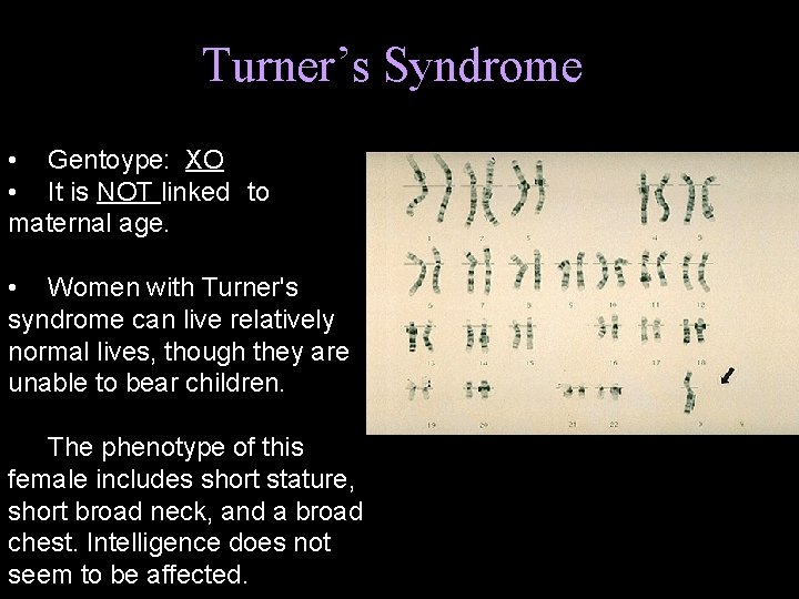 Turner’s Syndrome Turner’s syndrome: Genotype: ______ • Gentoype: XO • It is NOT linked