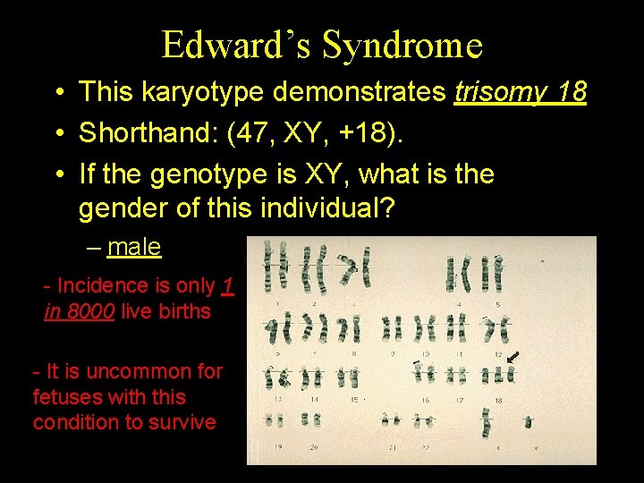 Edward’s Syndrome • This karyotype demonstrates trisomy 18 • Shorthand: (47, XY, +18). •