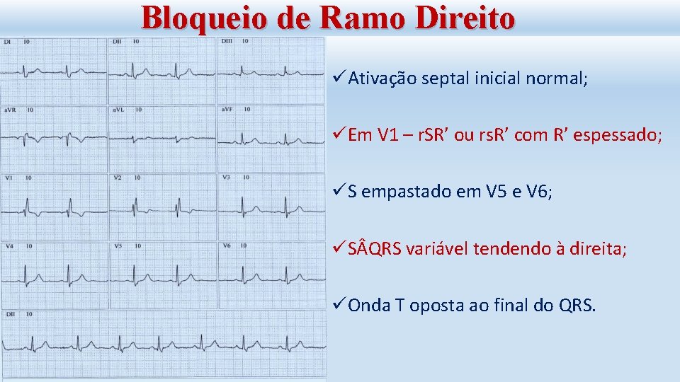 Bloqueio de Ramo Direito üAtivação septal inicial normal; üEm V 1 – r. SR’