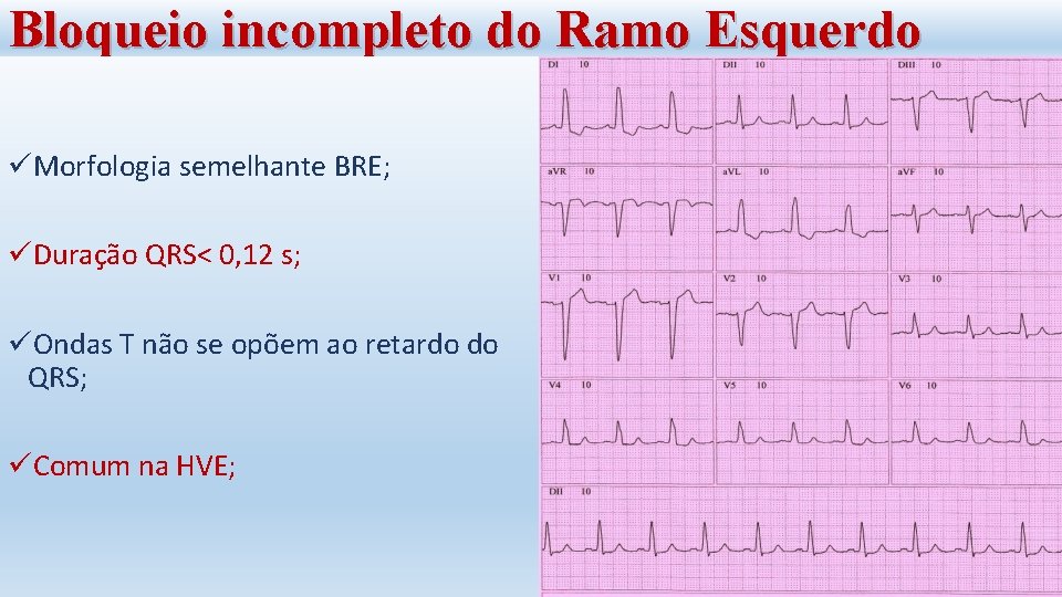 Bloqueio incompleto do Ramo Esquerdo üMorfologia semelhante BRE; üDuração QRS< 0, 12 s; üOndas