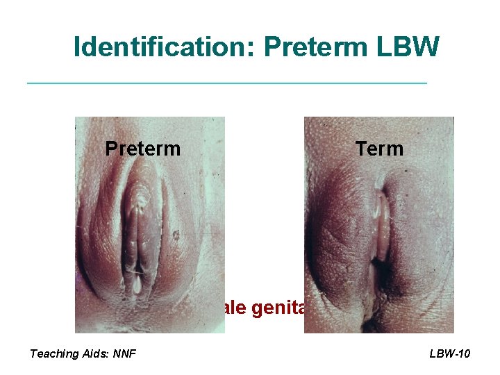 Identification: Preterm LBW Preterm Term Female genitalia Teaching Aids: NNF LBW-10 