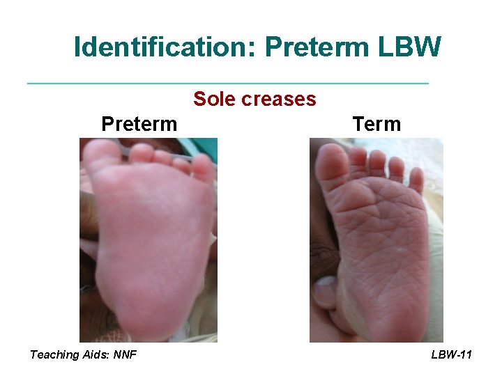 Identification: Preterm LBW Sole creases Preterm Teaching Aids: NNF Term LBW-11 