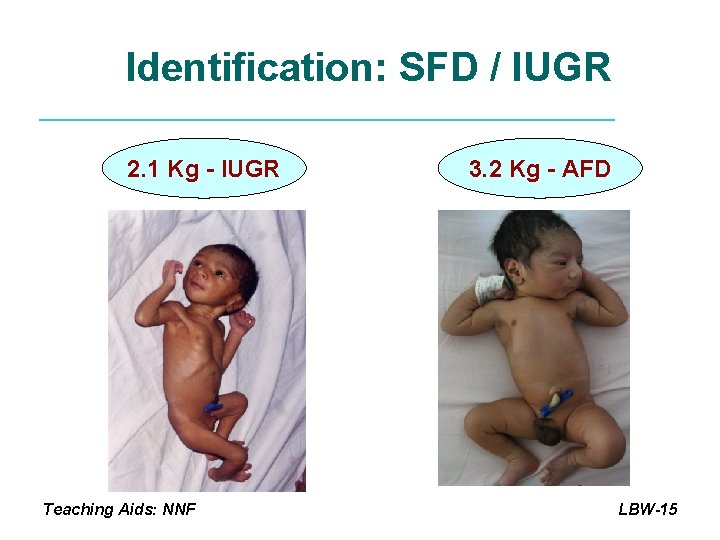 Identification: SFD / IUGR 2. 1 Kg - IUGR Teaching Aids: NNF 3. 2