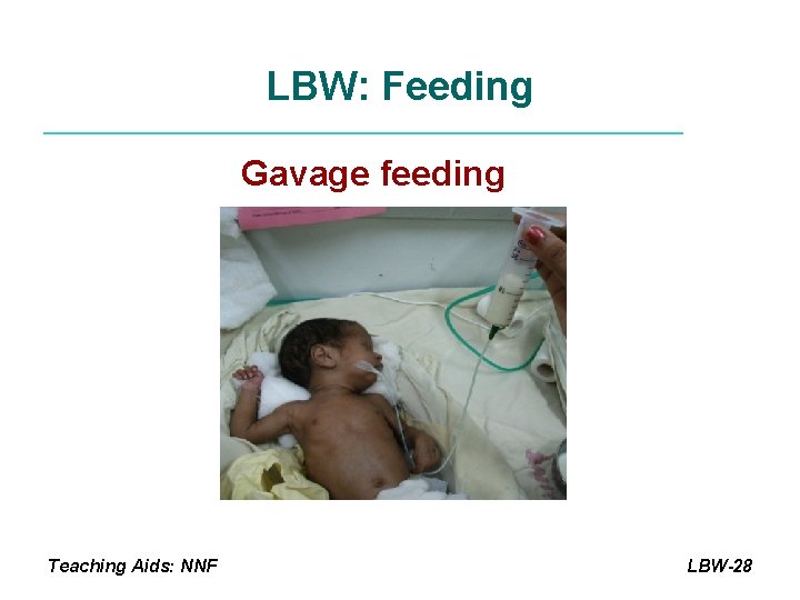 LBW: Feeding Gavage feeding Teaching Aids: NNF LBW-28 
