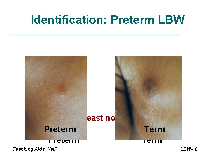 Identification: Preterm LBW Breast nodule Preterm Teaching Aids: NNF Term LBW- 8 
