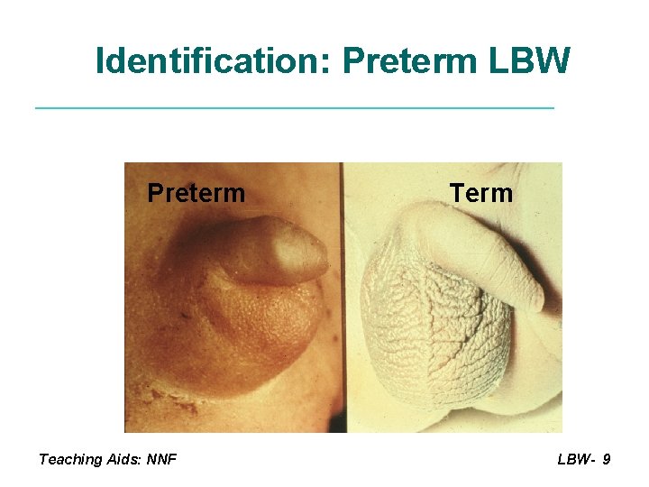 Identification: Preterm LBW Preterm Term Male genitalia Teaching Aids: NNF LBW- 9 