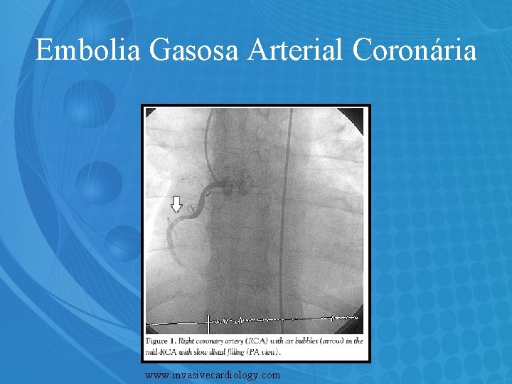 Embolia Gasosa Arterial Coronária www. invasivecardiology. com 