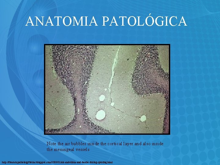 ANATOMIA PATOLÓGICA Note the air bubbles inside the cortical layer and also inside the