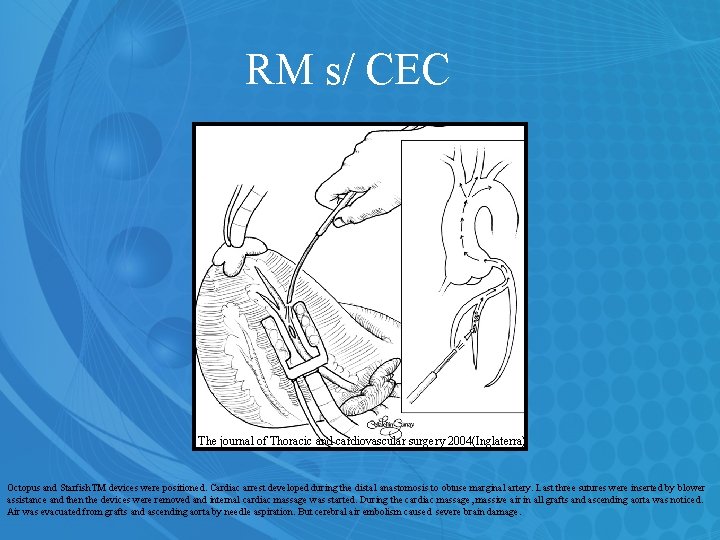 RM s/ CEC The journal of Thoracic and cardiovascular surgery 2004(Inglaterra) Octopus and Starfish.