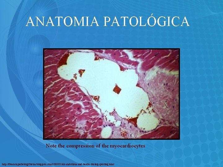 ANATOMIA PATOLÓGICA Note the compression of the myocardiocytes http: //forensicpathologyforum. blogspot. com/2009/01/air-embolism-and-deaths-during-sporting. html 