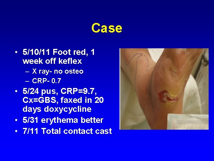 Case • 5/10/11 Foot red, 1 week off keflex – X ray- no osteo