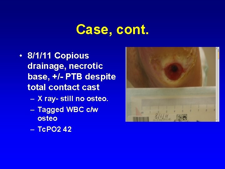 Case, cont. • 8/1/11 Copious drainage, necrotic base, +/- PTB despite total contact cast